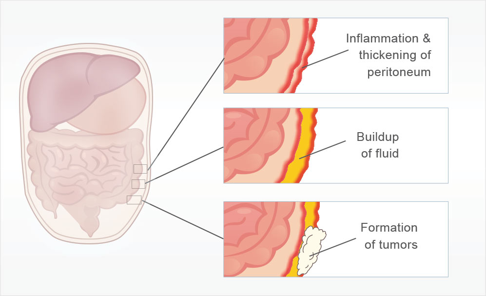 peritoneal-mesothelioma-causes-treatment-survival-rates