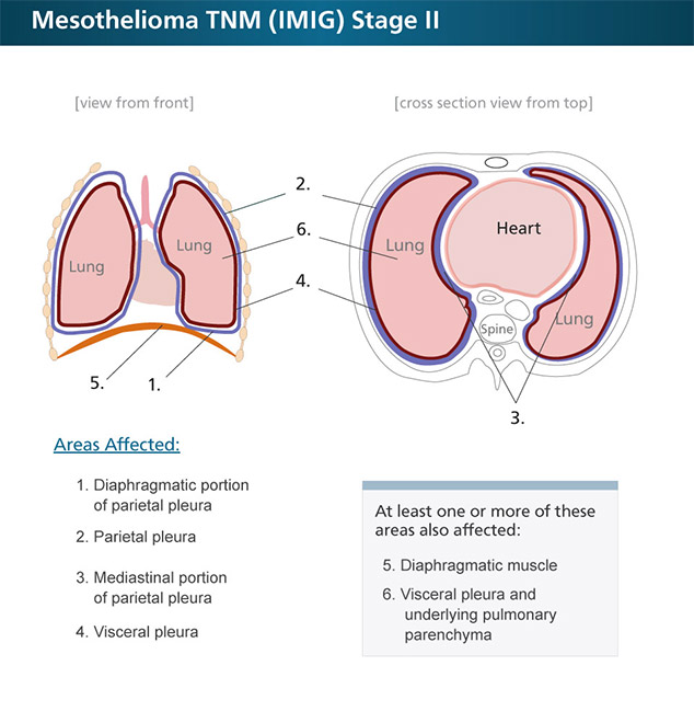 Pleural Mesothelioma Stages mesothelioma stages staging systems what your stage means Pleural Mesothelioma Stages mesothelioma stages staging systems what your stage means