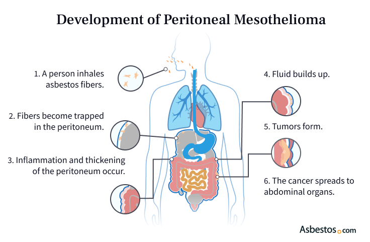 Diagram showing how asbestos fibers can lead to peritoneal mesothelioma