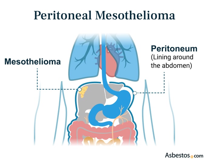 Diagram showing where peritoneal mesothelioma develops tumors in the abdominal cavity
