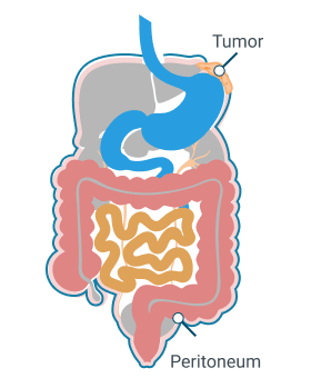 Stage 1 of peritoneal mesothelioma