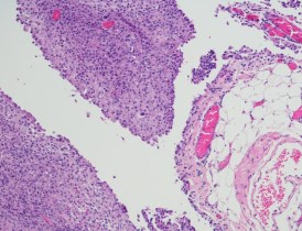 Peritoneal mesothelioma cells Peritoneal mesothelioma cells