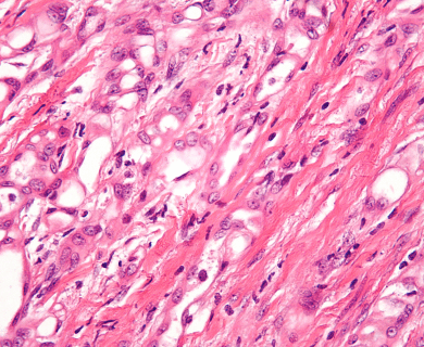Microscope view example of an Adenomatoid cell