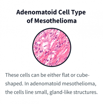 Adenomatoid Cell Type of Mesothelioma: These cells can be either flat or cube-shaped. In adenomatoid mesothelioma, the cells line small, gland-like structures. A microscopic photo depicts stained adenoma cells that are narrow and pink with dark purple nuclei.