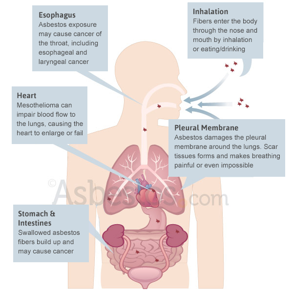 Causes Of Mesothelioma How Asbestos Causes Mesothelioma