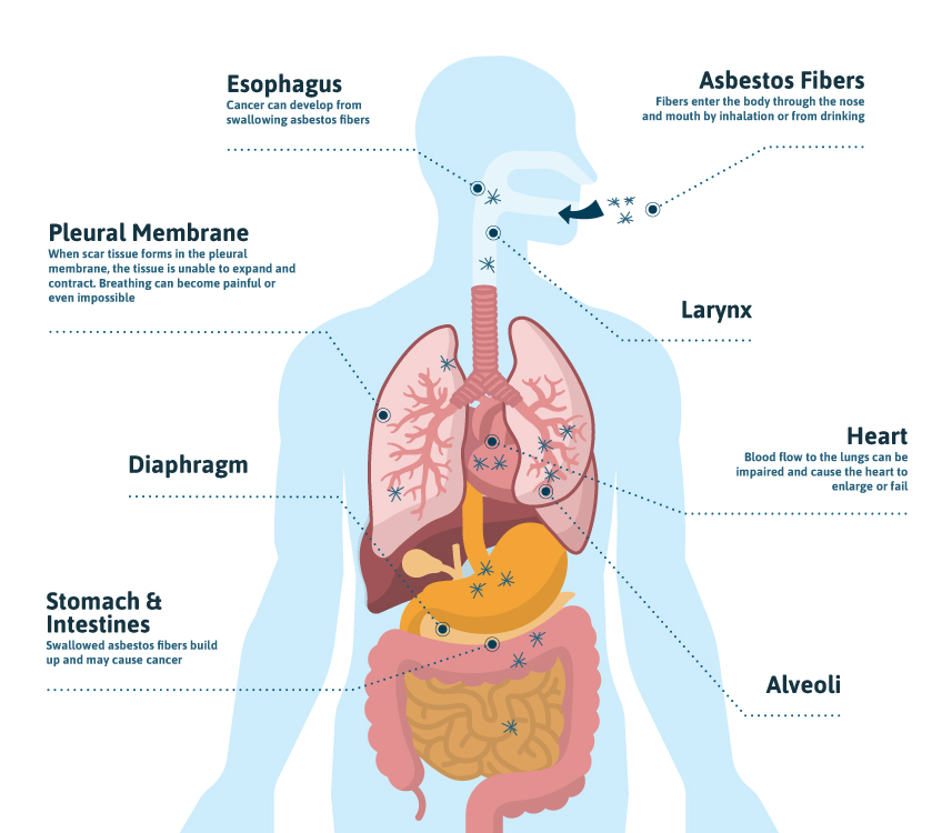 Peritoneal Asbestos Is A Uncommon Illness