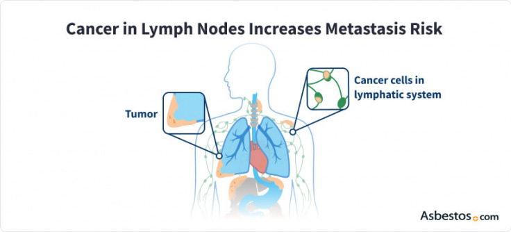 Cancerous tumors spreading to lymph nodes