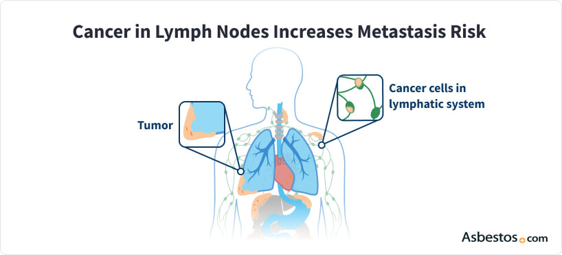 Cancerous tumors spreading to lymph nodes