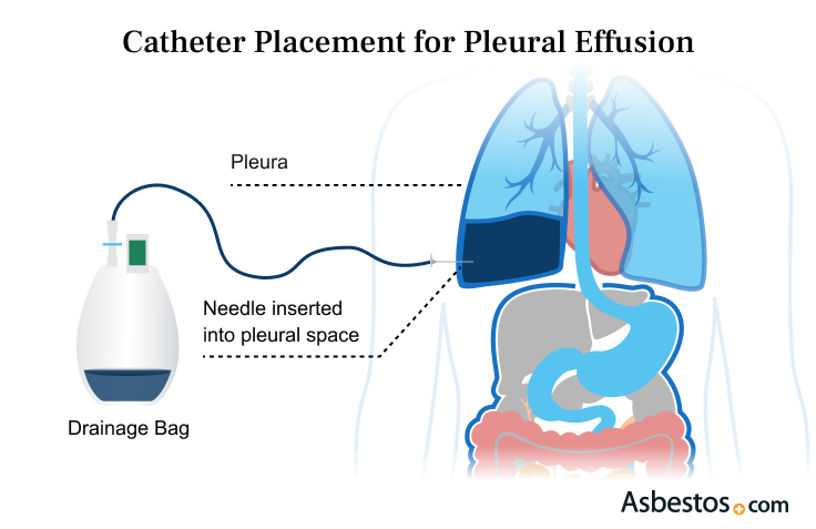 Catheter Placement for Pleural Effusion