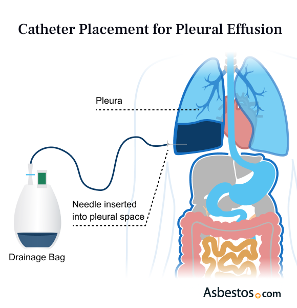Catheter Placement for Pleural Effusion