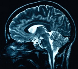 Chemo brain