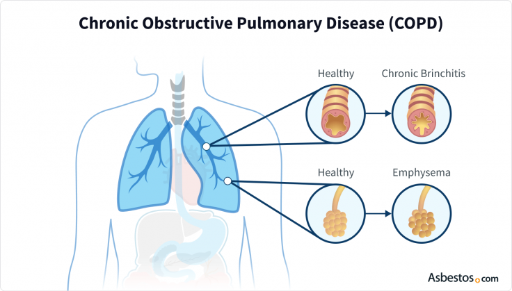 Image of lung conditions involved in chronic obstructive pulmonary disease (COPD). Two examples depict a healthy airway compared to constricted bronchi during bronchitis and healthy alveoli compared to inflamed air sacs during emphysema.