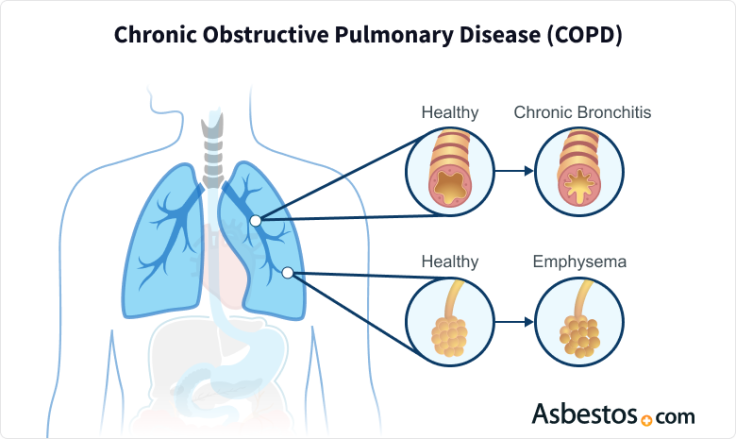Image of lung conditions involved in chronic obstructive pulmonary disease (COPD). Two examples depict a healthy airway compared to constricted bronchi during bronchitis and healthy alveoli compared to inflamed air sacs during emphysema.