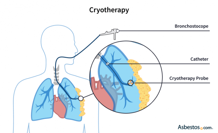 Illustration depicting a bronchoscope guiding a cryotherapy probe into the left lung to deliver cryotherapy to tumors in the region.