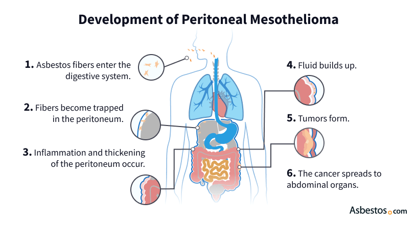 An illustration that depicts how peritoneal mesothelioma develops from asbestos fibers.