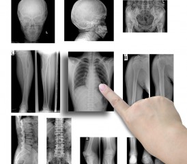 Finger pointing to chest X-ray