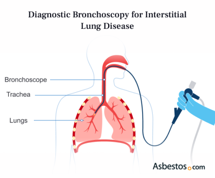 Diagnostic Bronchoscopy for Interstitial Lung Disease