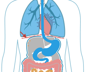 Asbestos Fibers in the diaphragm.