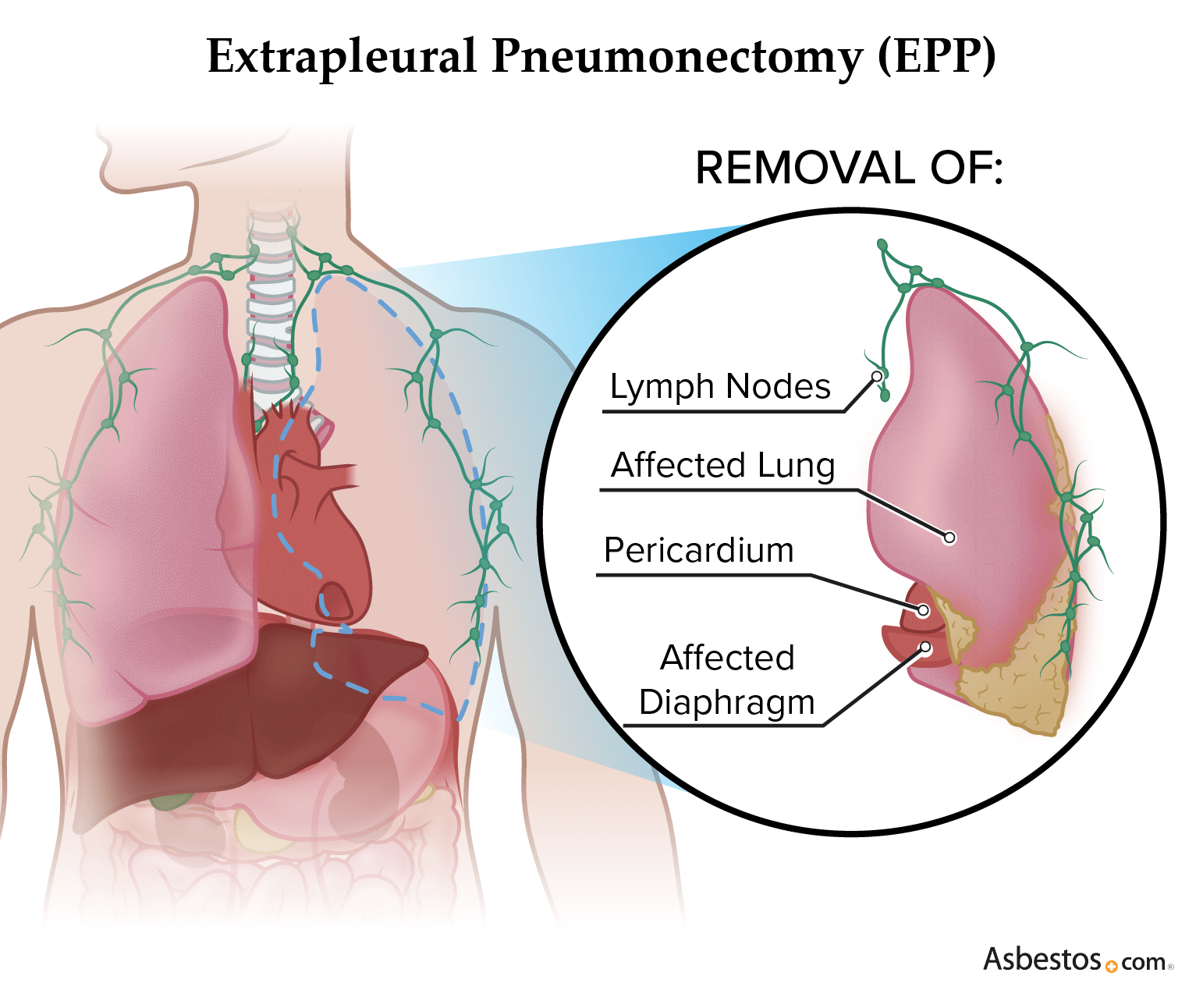 Graphic showing what an extrapleural pneumonectomy (EPP) removes.