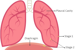Stage 1 Stage 2 Mesothelioma Symptoms Treatments Stage 1 Stage 2 Mesothelioma Symptoms Treatments
