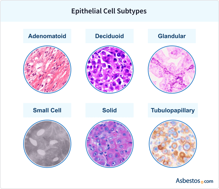Cell Subtypes of Epithelial Mesothelioma