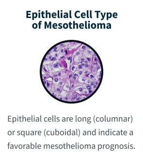 Epithelial Cell Type of Mesothelioma