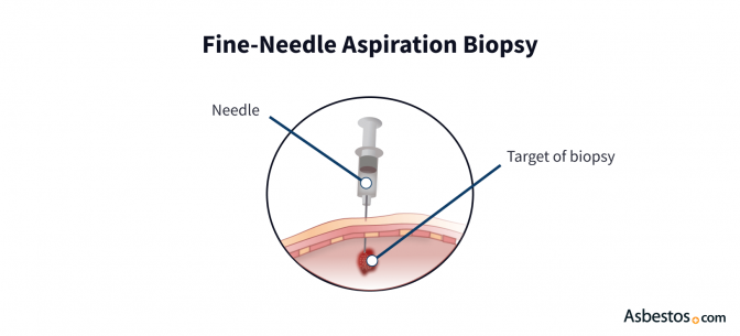 Illustrated depiction of a fine-needle aspiration biopsy showing a needle taking a biopsy sample from a lesion under layers of skin and muscle.