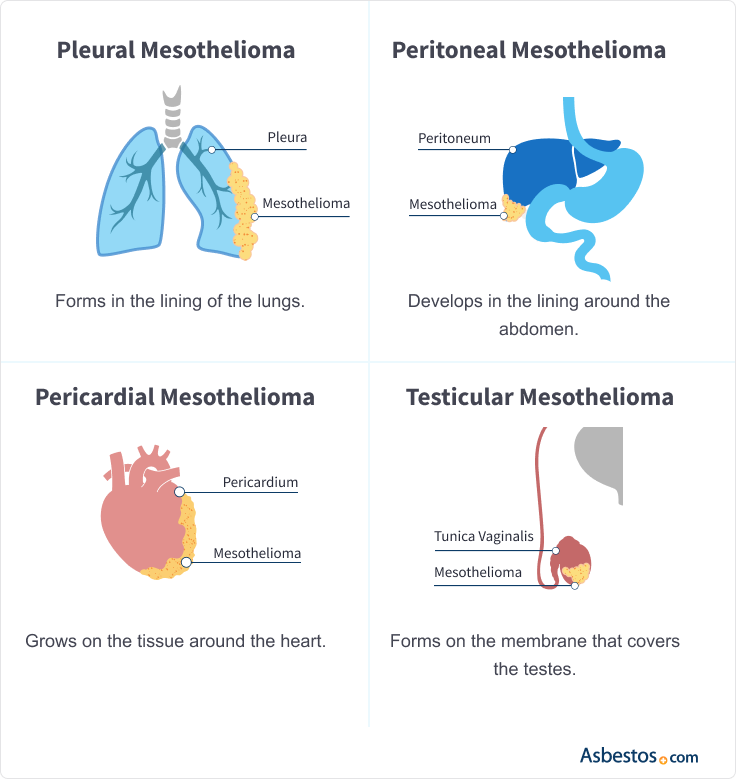 Graphic showing the four types of mesothelioma.