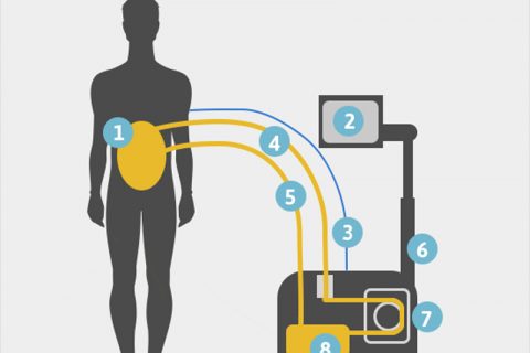 HIPEC machine diagram