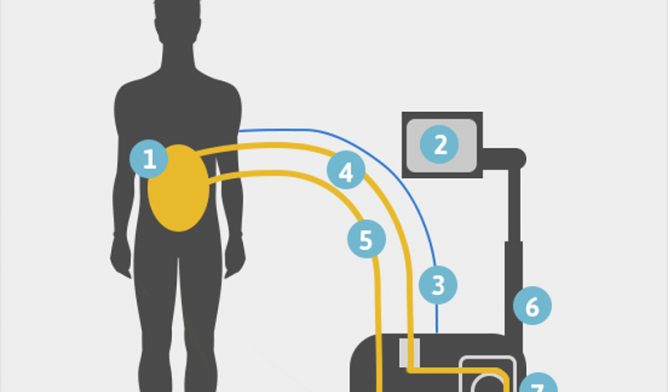 HIPEC machine diagram