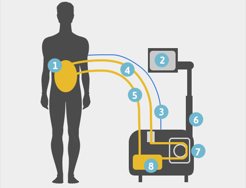 HIPEC machine diagram