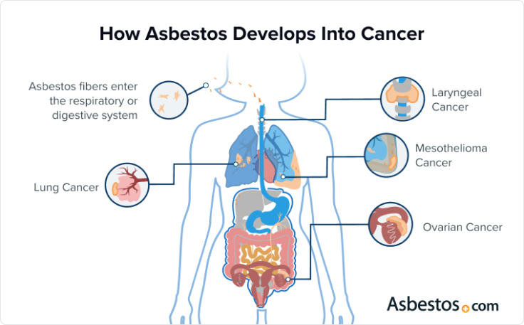 How asbestos exposure develops into cancer in different parts of the body