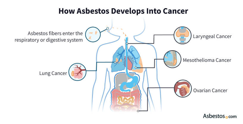 How asbestos develops into different types of cancer