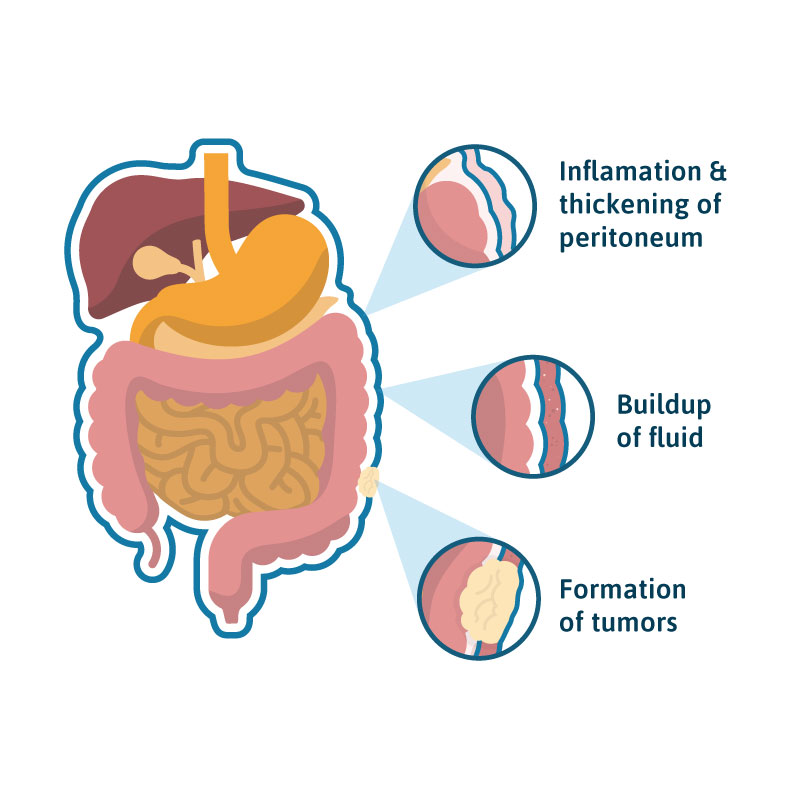 peritoneal-mesothelioma-causes-treatment-survival-rates