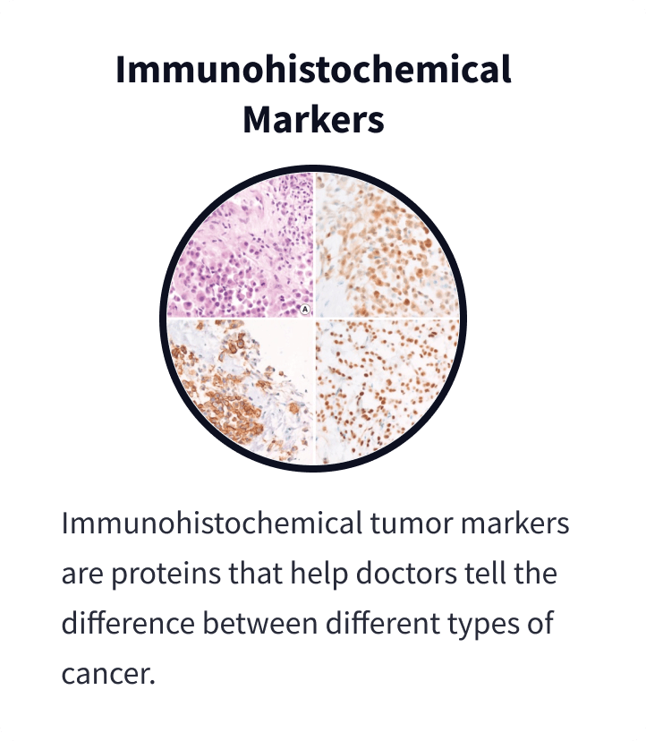 Immunohistochemical Markers: Immunohistochemical tumor markers are proteins that help doctors tell the difference between different types of cancer. A composite image taken under a microscope shows cells of various types stained in different colors to highlight differences in cancer diagnosis.