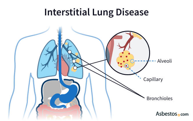 Diagram of lungs showing bronchioles, alveoli and capillaries. Scar tissue has developed on the alveoli.