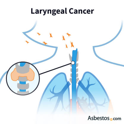 calretinin negative mesothelioma