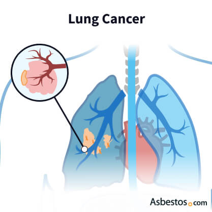 Cancer forming on the air sacks inside the lung.