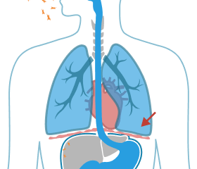 Asbestos Fibers in the lung tissue.