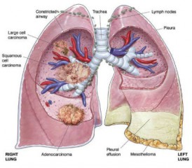 Diagram of pleural effusion in lungs