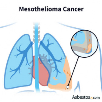 Mesothelioma forming on the outer edge of the lung