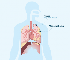 Where pleural mesothelioma forms