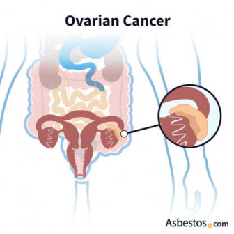 Cancer forming on the ovaries