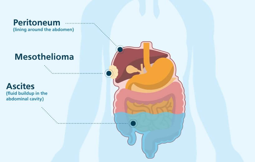 Paracentesis Anatomy