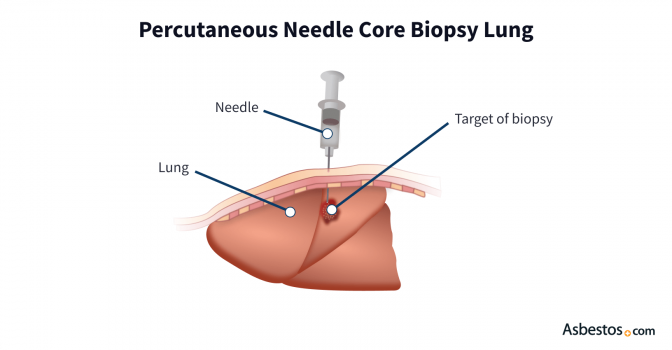 Percutaneous Needle Core Lung Biopsy: An illustration depicts a needle passing through layers of skin and muscle tissue to enter the lung and extract cellular fluid for a biopsy sample from a target mass.
