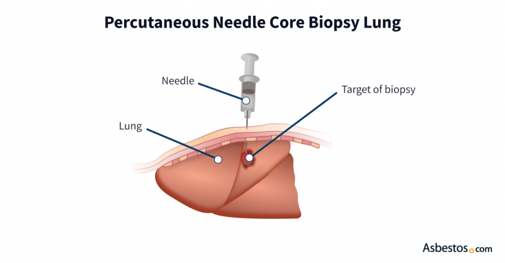 Percutaneous Needle Core Lung Biopsy: An illustration depicts a needle passing through layers of skin and muscle tissue to enter the lung and extract cellular fluid for a biopsy sample from a target mass.
