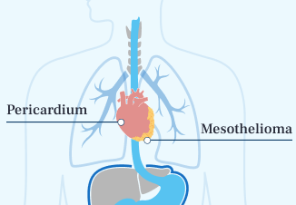 Pericardial Mesothelioma Illustration