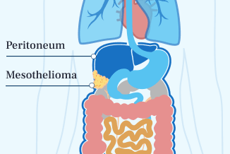 Peritoneal Mesothelioma Illustration