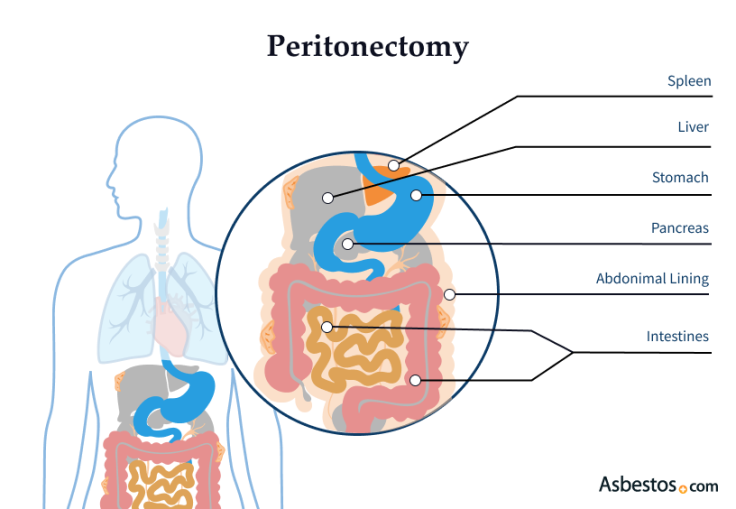 Diagram showing the six organs involved in a peritonectomy or cytoreductive surgery