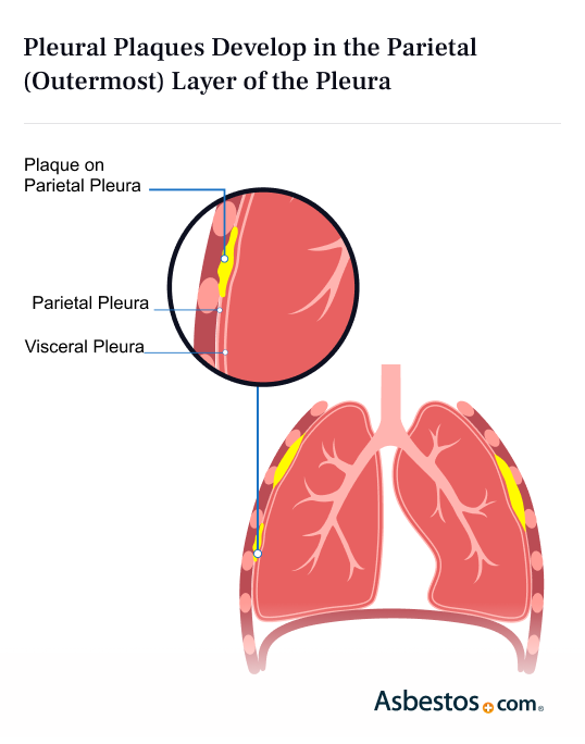 Amazing Mesothelioma Versus Pleural Plaques Landscape Photography Amazing Mesothelioma Versus Pleural Plaques Landscape Photography